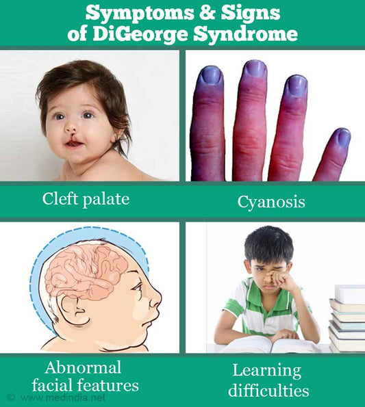 DiGeorge syndrome